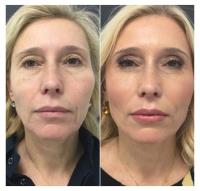 Oxygen & Deep Cleaning Facial image 5